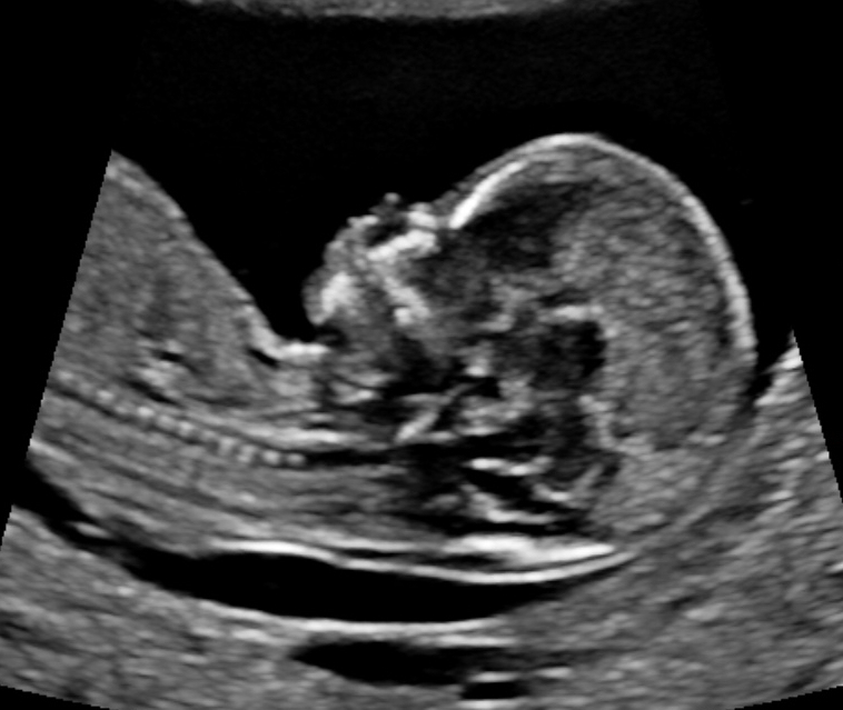 Ultrasound machine and probes